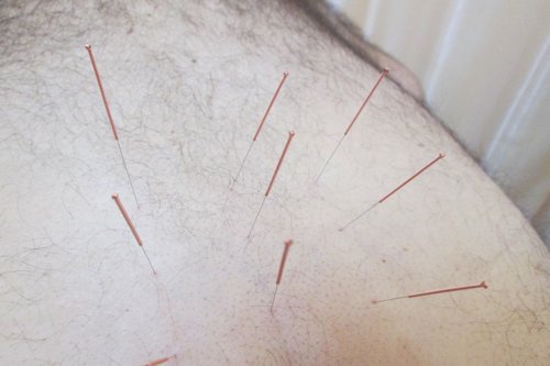 Paul with 9 Needles in his Back - Scene 9