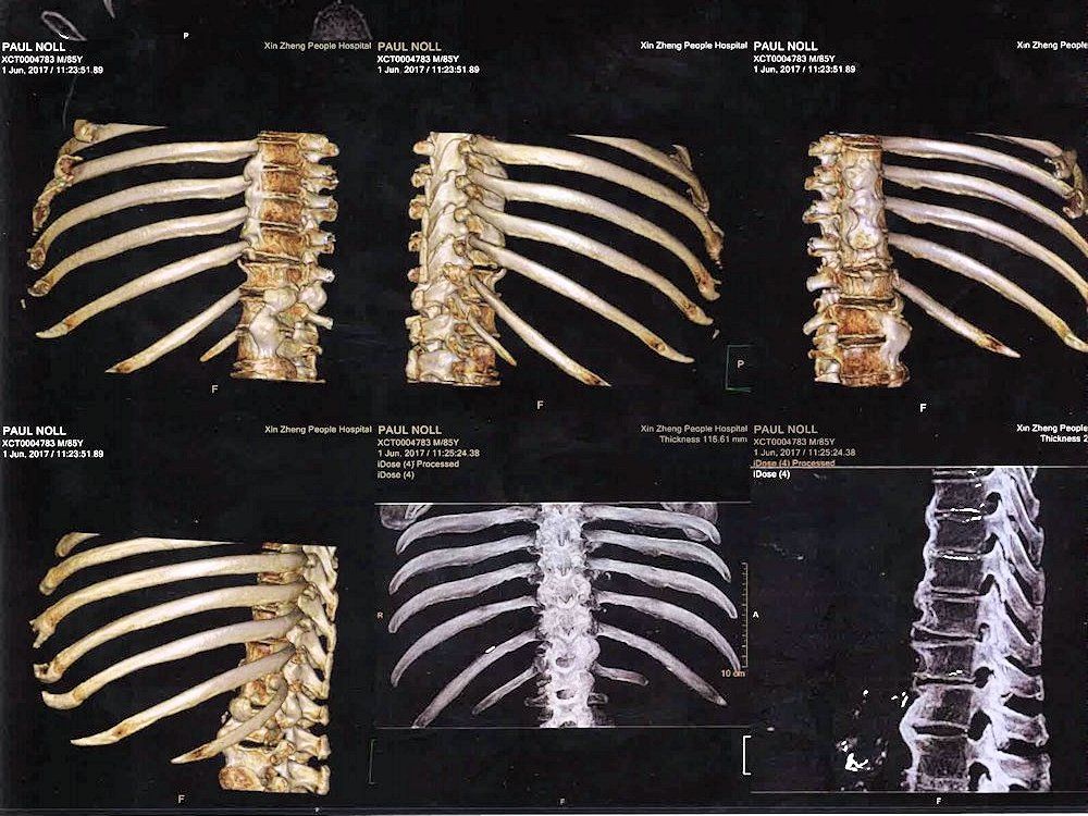 CT Rib Scan  