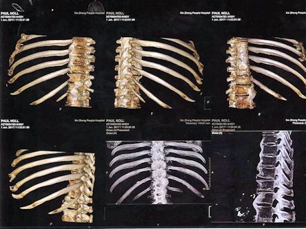 CT Rib Scan - Page 27