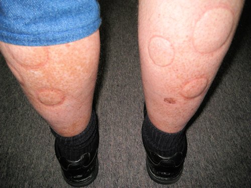 Paul's Legs after Suction Cups - Scene 18